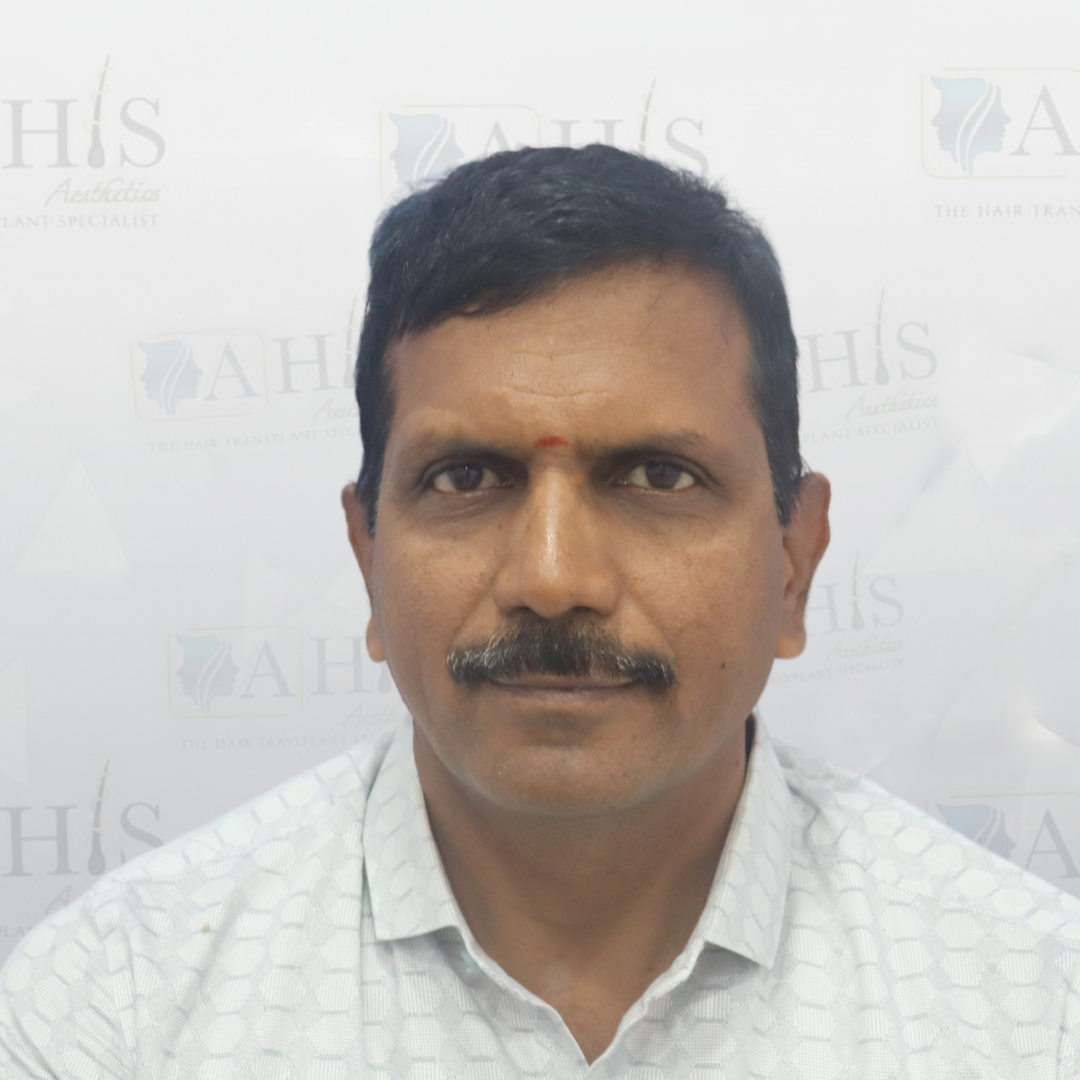 Frontal Hairline & Density Improvement — after hair transplant at AHIS Aesthetics Mysore