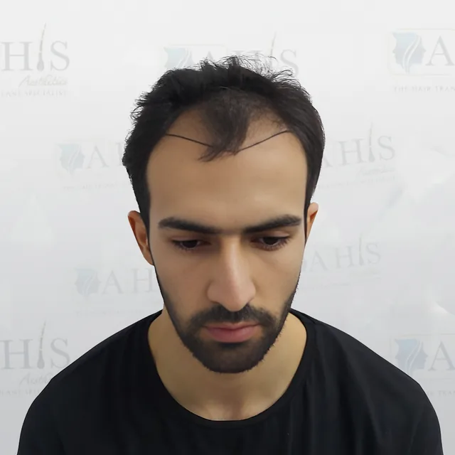 Hairline & Frontal Density Restoration — before hair transplant at AHIS Aesthetics Mysore