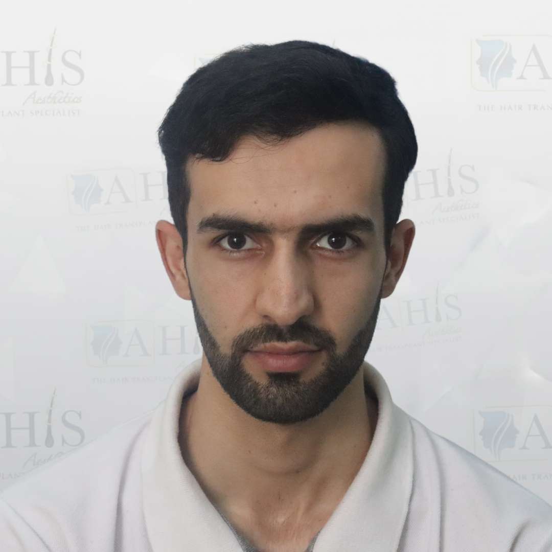 Hairline & Frontal Density Restoration — after hair transplant at AHIS Aesthetics Mysore