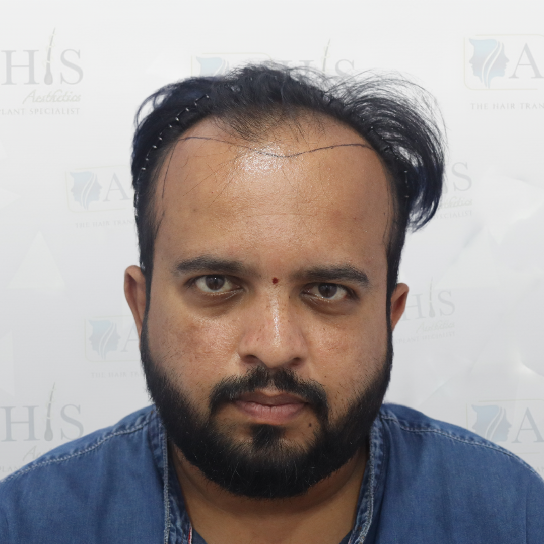 Frontal Hairline & Temple Restoration — before hair transplant at AHIS Aesthetics Mysore
