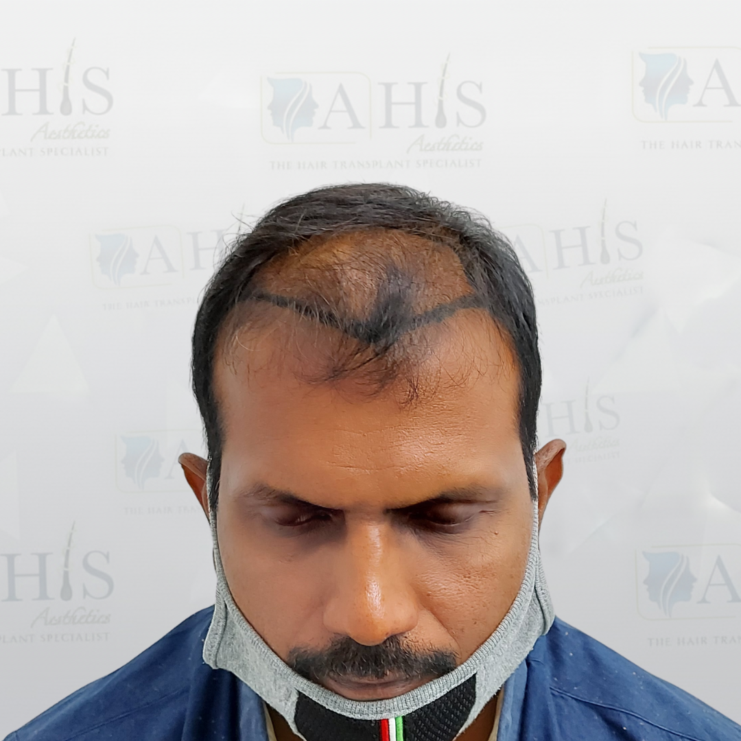 Frontal Hairline & Density Improvement — before hair transplant at AHIS Aesthetics Mysore