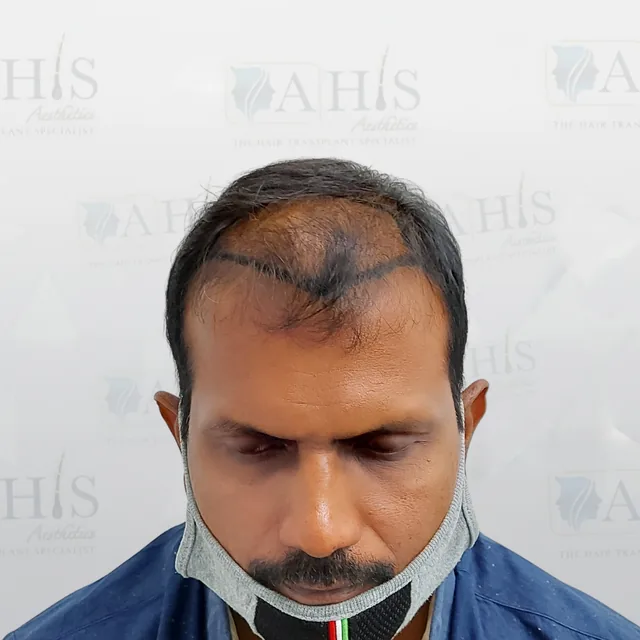 Frontal Hairline & Density Improvement — before hair transplant at AHIS Aesthetics Mysore